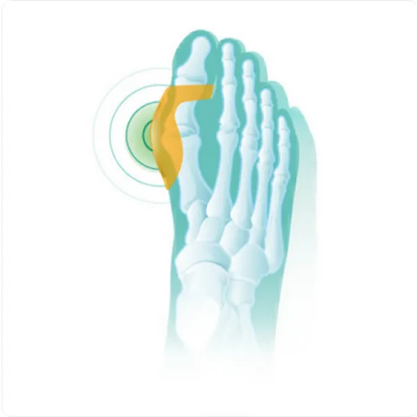 Бурсопротектор Oppo 6443